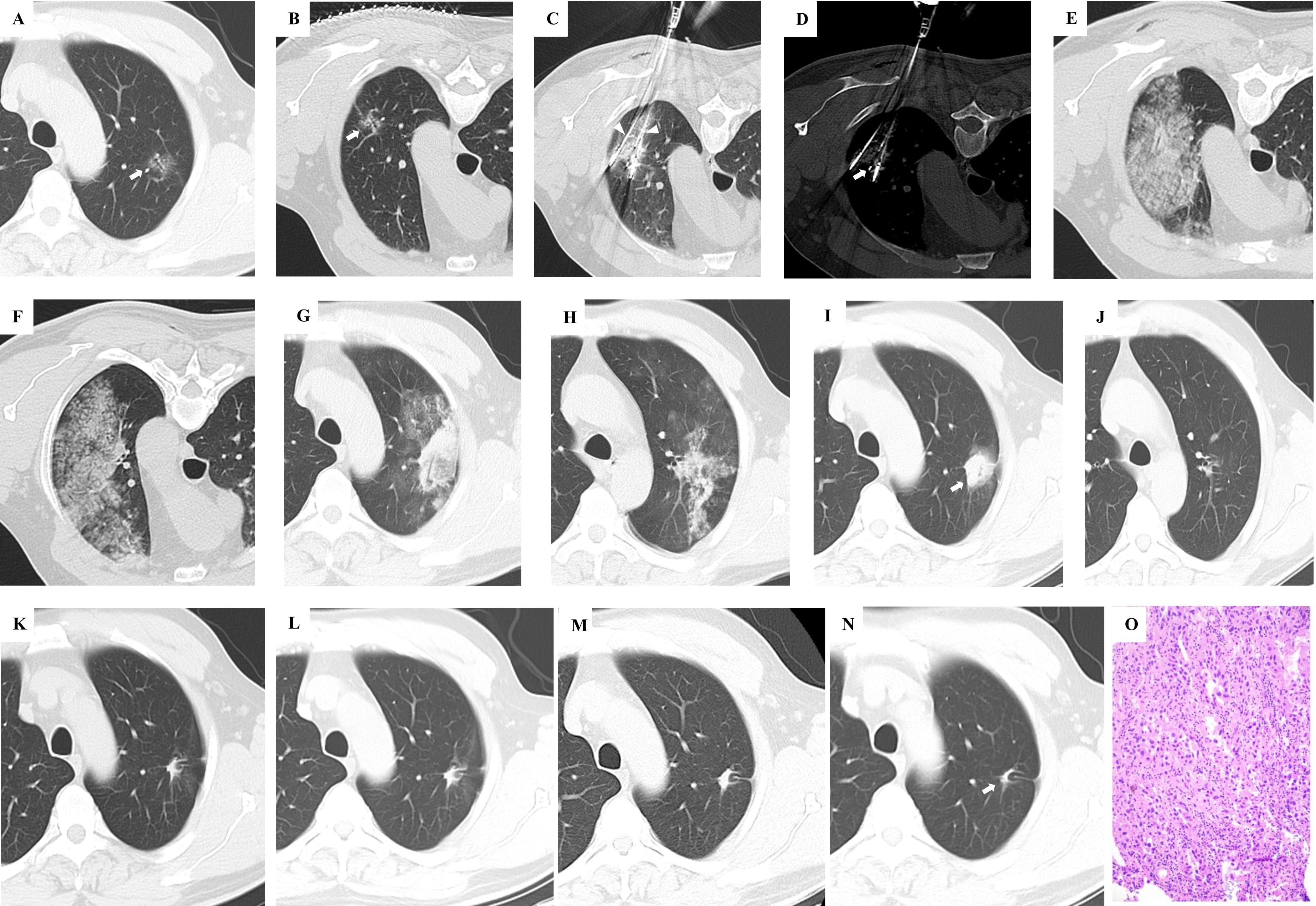 Series of thoracic CT scans labeled A to N showing lung features with various patterns of opacities and densities. Panel O contains a histopathology image with a pink and purple stained tissue sample, indicating cellular structures under magnification.