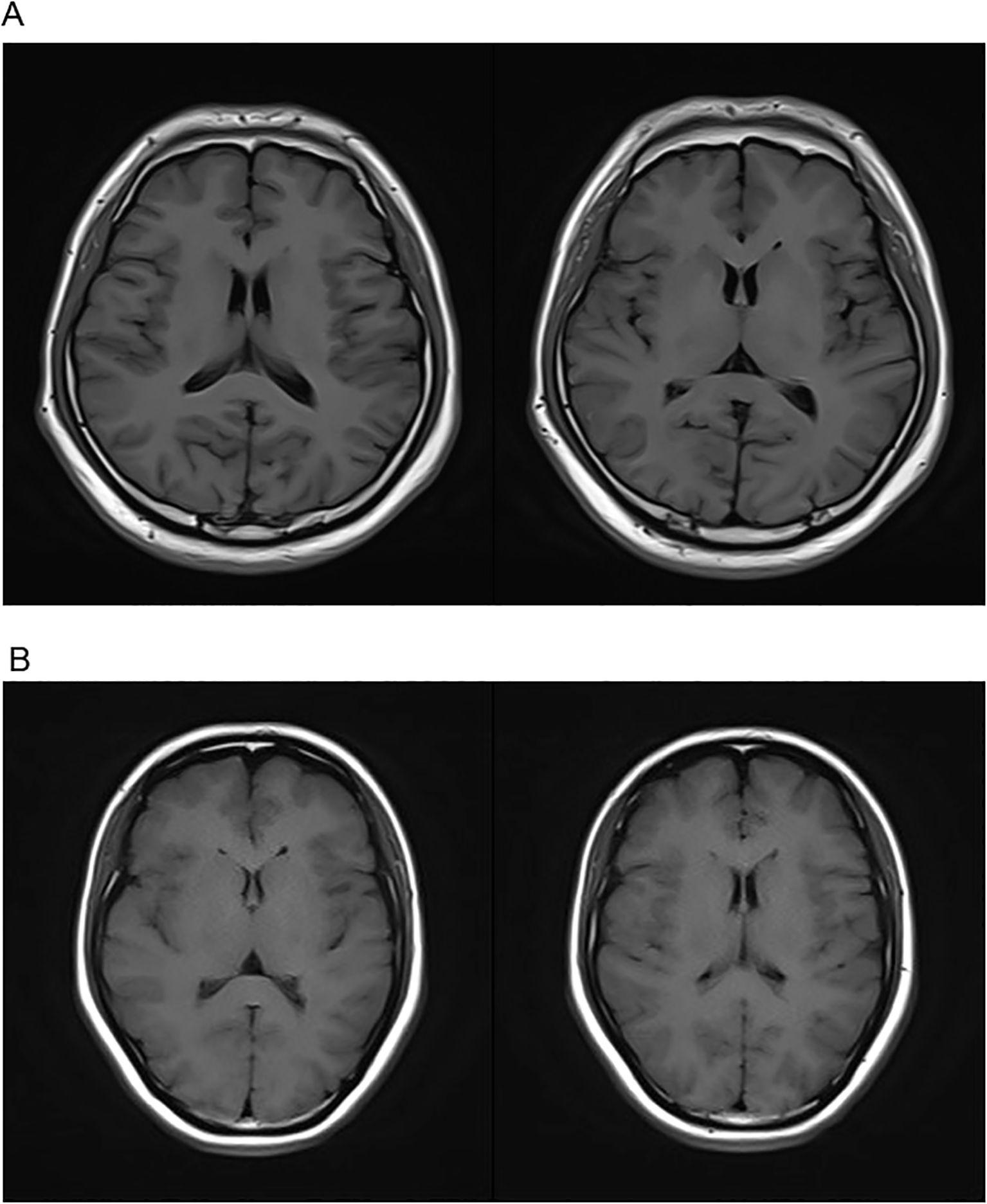 MRI scans show axial brain images in two rows, labeled A and B, each containing two side-by-side scans. Both rows capture different views of brain structures, highlighting variations in size and shape of the ventricles and surrounding tissues. The images emphasize detailed contrasts between gray and white matter.