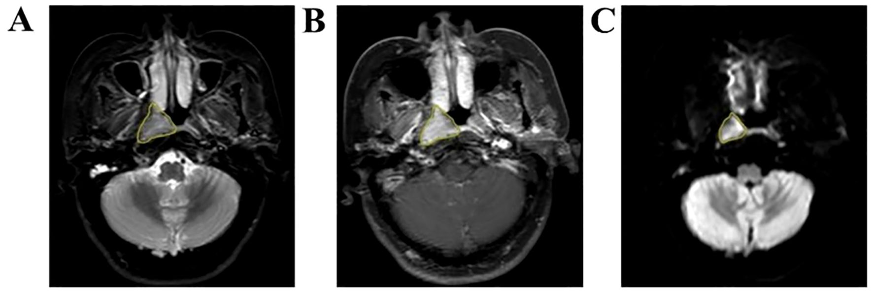 Three MRI images labeled A, B, and C show axial views of the brain. Each image highlights a triangular area outlined in yellow near the brainstem. The surrounding areas vary in brightness.