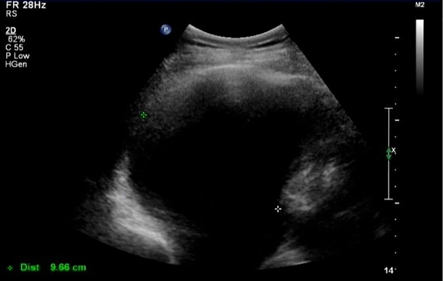 Ultrasound image showing a cross-sectional view with varying shades of gray, indicating tissue density. Measurement of 9.66 centimeters noted at the bottom. Labels and settings appear on the left side.