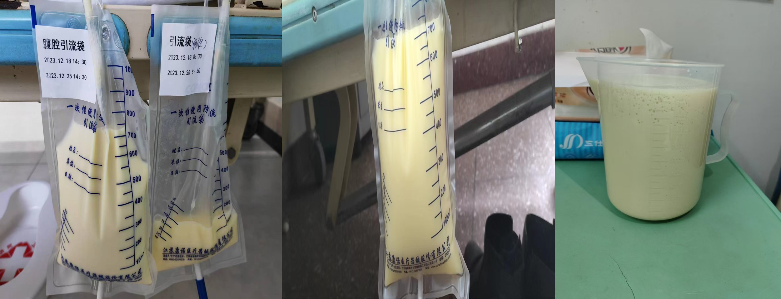 Three images show containers with a yellowish liquid. The first two images feature medical drainage bags with measurement markings and date labels in Chinese. The third image displays a transparent measuring jug filled with a similar liquid, placed on a green surface.