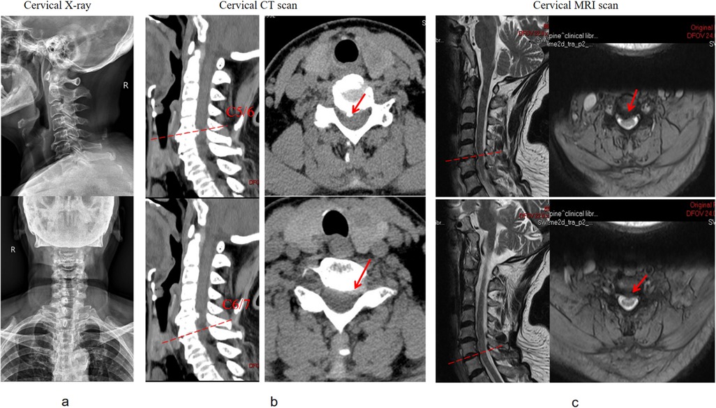 Cervical spine imaging comparison shows X-ray, CT, and MRI scans. X-ray images depict lateral and frontal views. CT scans show sagittal and axial slices highlighting C5/C6 and C6/C7 levels. MRI scans provide sagittal and axial views, indicating areas of interest with arrows.