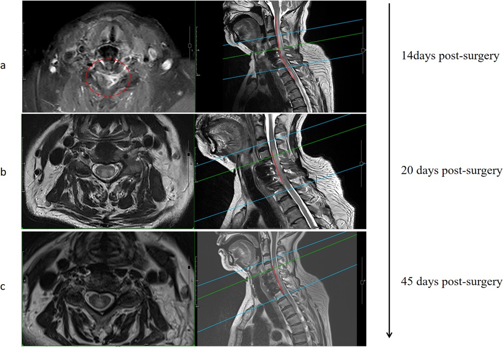 MRI scans showing cervical spine images at three different times post-surgery: 14 days, 20 days, and 45 days. Each row includes an axial view on the left and a sagittal view on the right. Changes in the spinal region are visible in each time frame.