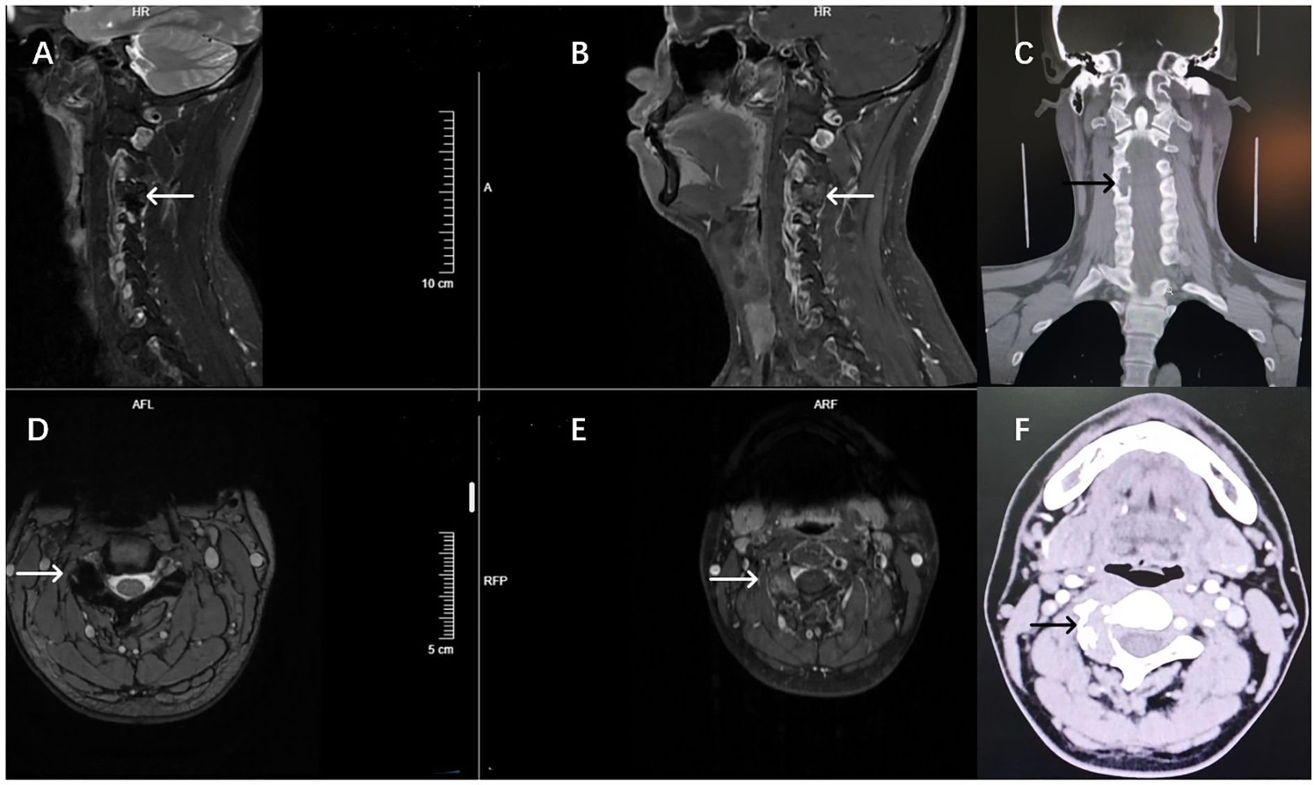 Composite of six medical imaging scans labeled A to F, illustrating different views and sections of the cervical spine and neck region. Scans A and B are sagittal MRI images showing abnormalities marked by white arrows. Scan C is a coronal CT image with a black arrow indicating a specific area. Scans D and E are axial MRI images with white arrows pointing to areas of interest. Scan F is an axial CT image with a black arrow marking a notable spot.