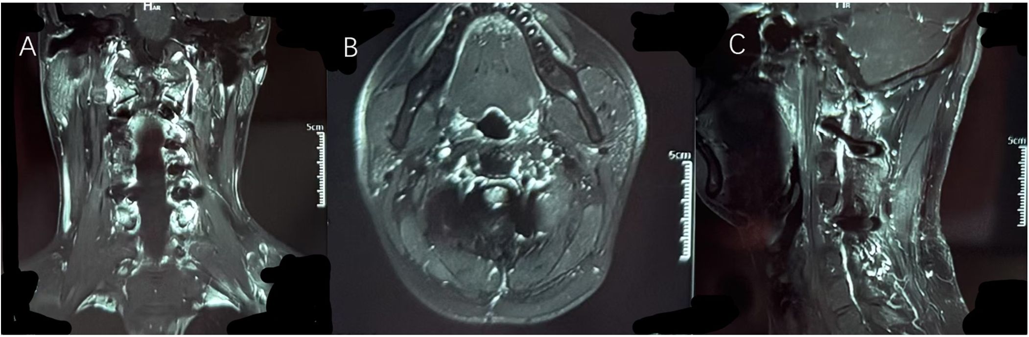 Three-panel MRI scans of the neck region. Panel A shows a coronal view, Panel B an axial view, and Panel C a sagittal view. Bony and soft tissue structures are visible with varying contrasts.