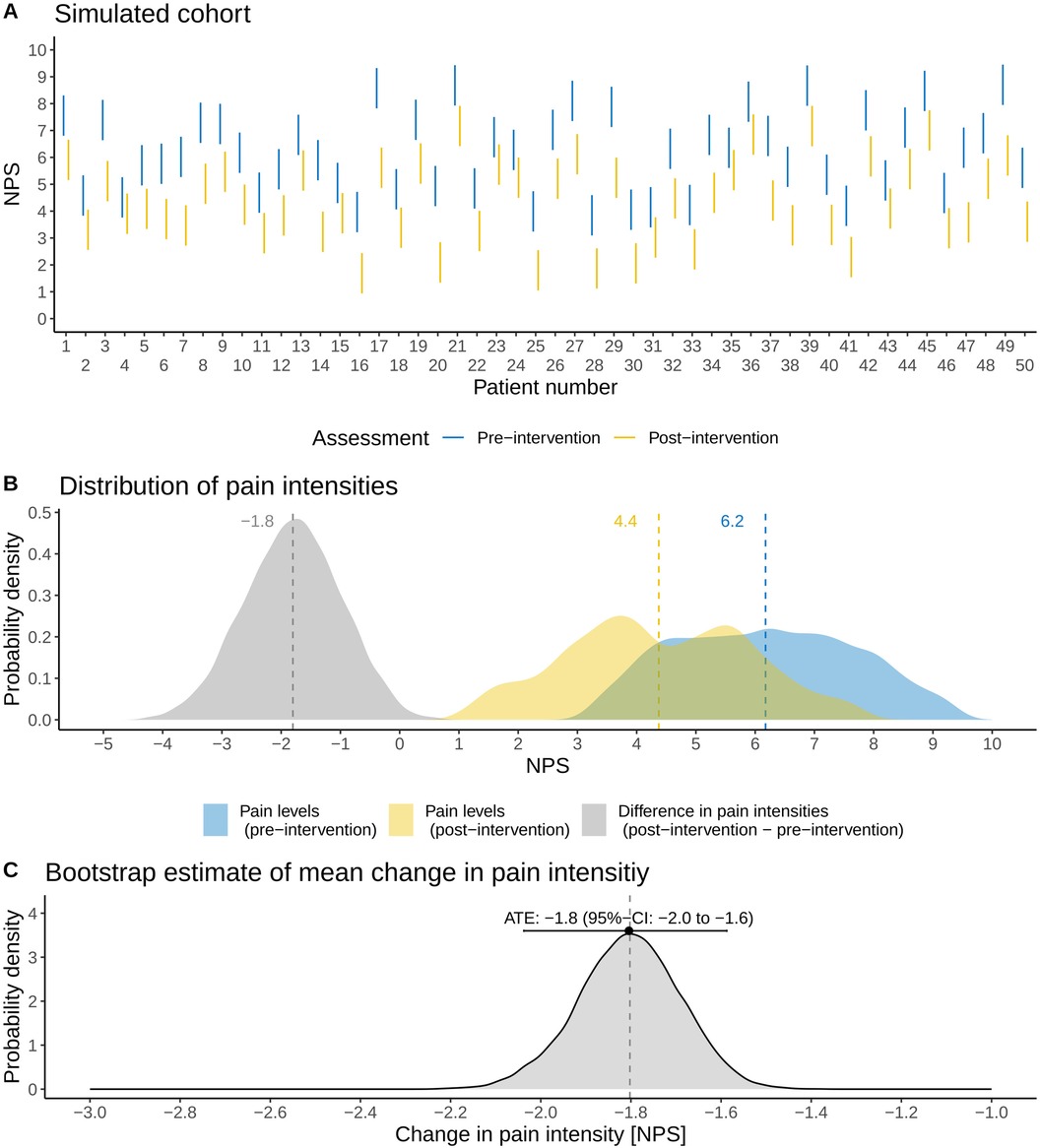Panel A shows pre- and post-intervention numerical pain scores (NPS) for a simulated cohort of 50 patients, with blue lines representing pre-intervention values and yellow lines indicating post-intervention values, generally showing decreased scores. Panel B presents probability density distributions of pain levels before and after intervention, along with their difference, highlighting an average reduction of 1.8 points. Panel C displays a bootstrap distribution of the mean change in pain intensity, with an average treatment effect (ATE) of −1.8 and a 95% confidence interval from −2.0 to −1.6, indicating a statistically significant reduction in pain following the intervention.