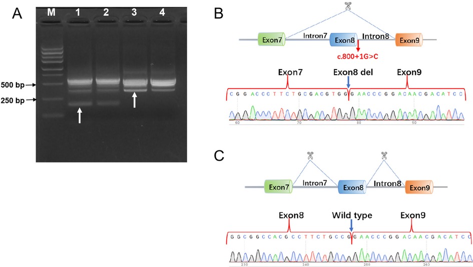 Gel electrophoresis and genetic sequencing analysis. Panel A shows a gel with bands indicating DNA fragments, with arrows pointing to specific bands. Panel B illustrates a genetic sequence with exon and intron labels, highlighting a mutation c.800+1G>C and a deletion in Exon 8 with a chromatogram. Panel C shows a wild type sequence, indicating Exon 7 and Exon 9 with corresponding chromatogram details.