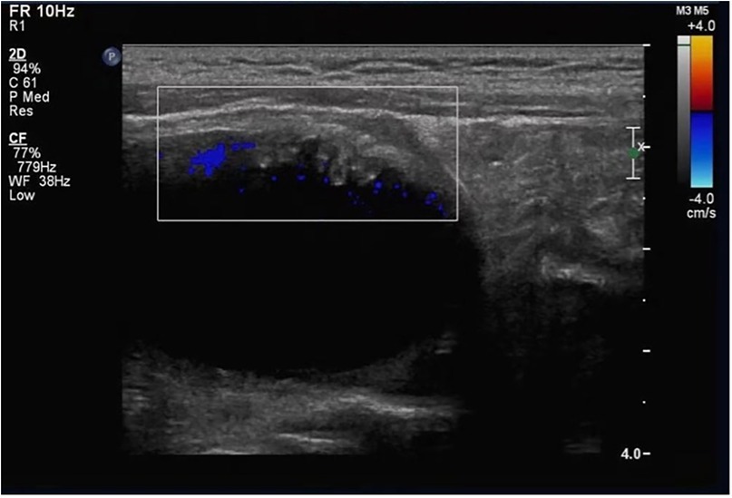 Ultrasound image showing a dark oval shape, likely representing a cyst or lesion, surrounded by tissue. Color Doppler displays blue spots indicating blood flow. Labels and settings are visible on the sides.
