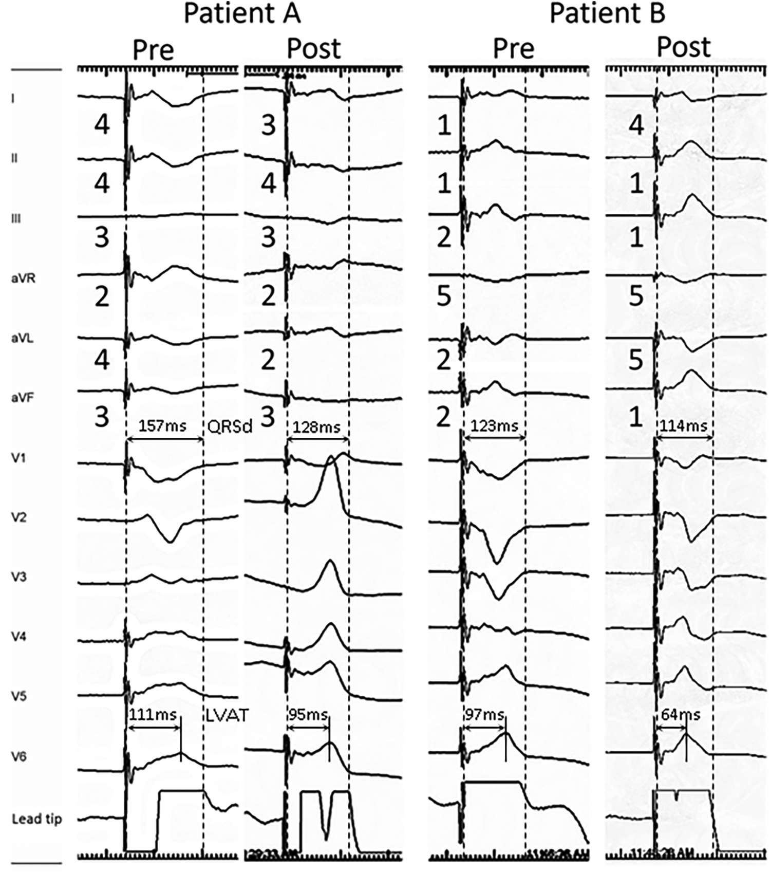 Electrocardiogram traces for Patients A and B, showing pre- and post-procedure results. Various ECG leads are displayed with QRS and LVAT measurements indicated. Patient A shows changes from 157 ms to 128 ms in QRS duration and from 111 ms to 95 ms in LVAT. Patient B shows changes from 123 ms to 114 ms in QRS duration and from 97 ms to 64 ms in LVAT.