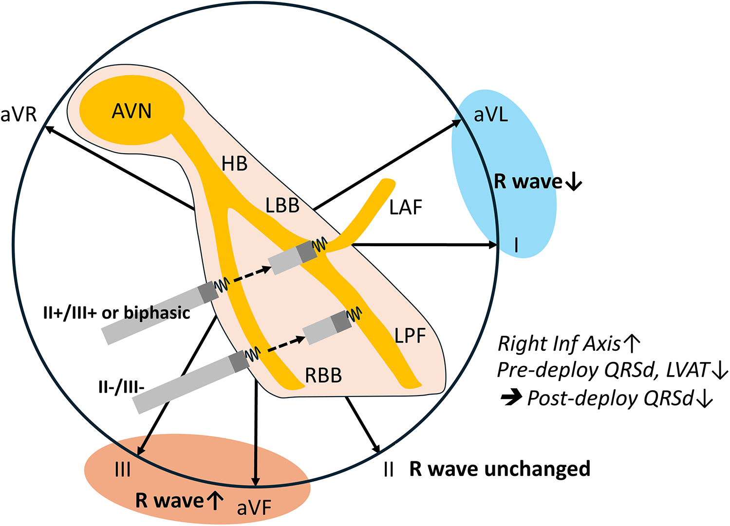 Diagram illustrating the cardiac conduction system with labeled pathways, including the atrioventricular node (AVN), His bundle (HB), left and right bundle branches (LBB, RBB), and left anterior and posterior fascicles (LAF, LPF). Arrows indicate the direction of electrical conduction. Electrocardiogram leads aVL, aVR, aVF, I, II, III label the surrounding areas, showing changes in R-wave direction and bipolar signals. Terms like \"Right Inf Axis↑\", \"Pre-deploy QRSd, LVAT↓\" and \"Post-deploy QRSd↓\" are noted to indicate changes in conduction.