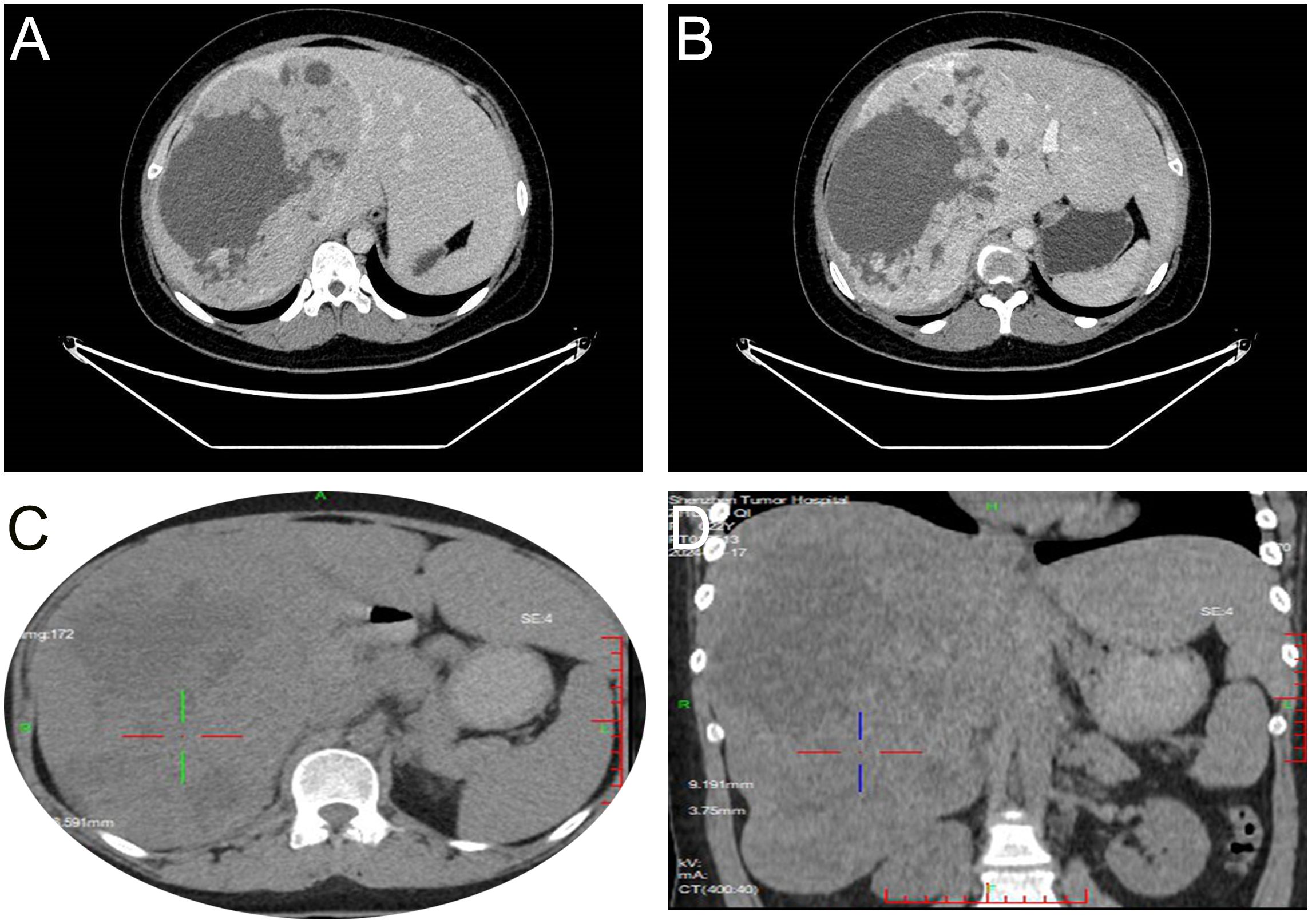 CT scan images labeled A, B, C, and D depict sections of the abdominal region. These scans show various cross-sectional views of the liver, spleen, and surrounding structures, highlighting changes in tissue density and organ size.