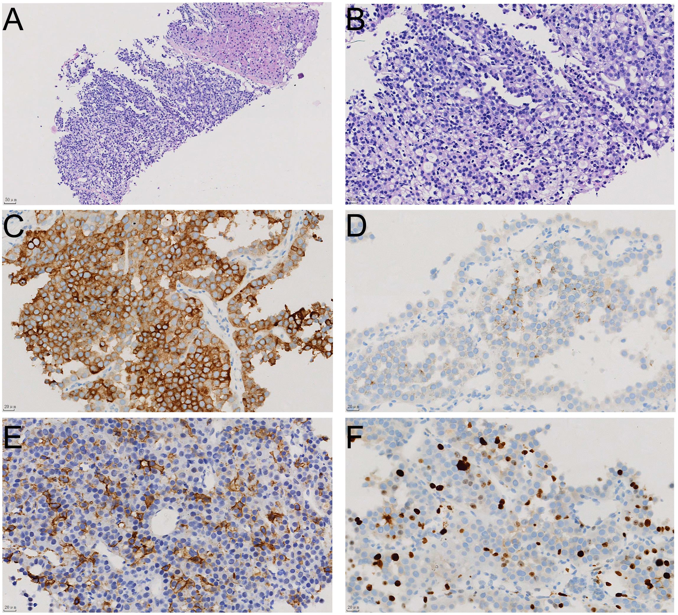 Histological slides show different staining techniques identifying cellular structures. Image A and B display H&E staining with distinct purple and pink colors highlighting tissue architecture. Image C through F present immunohistochemical staining demonstrating brown, varying staining intensities indicating different protein expressions within the tissues. Each panel is labeled from A to F, illustrating cellular morphology and staining characteristics under microscopic examination.