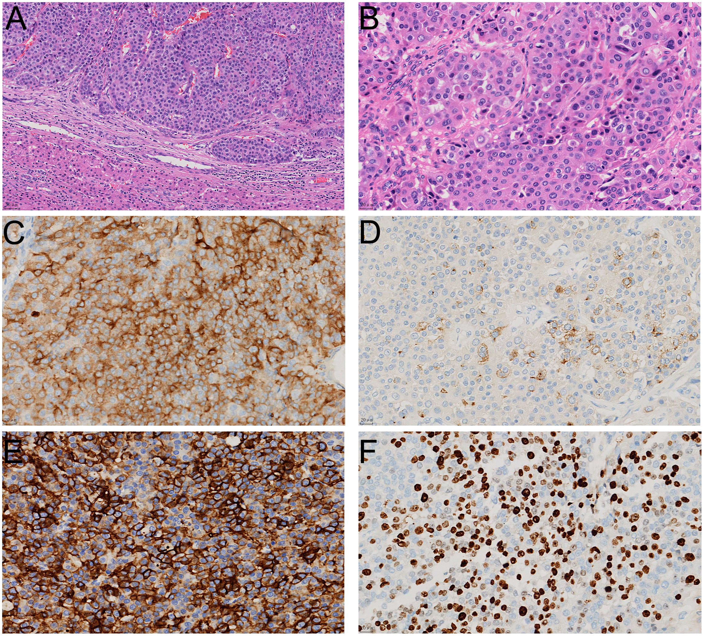 Histological images from a study showing different stainings. Panel A shows a hematoxylin and eosin-stained section with dense cell clusters. Panel B presents a closer view, highlighting cell nuclei. Panel C shows strong positive staining in brown for a protein, while Panel D exhibits weaker staining. Panel E reveals consistent brown staining throughout, and Panel F displays nuclear staining emphasizing cell nuclei in brown.
