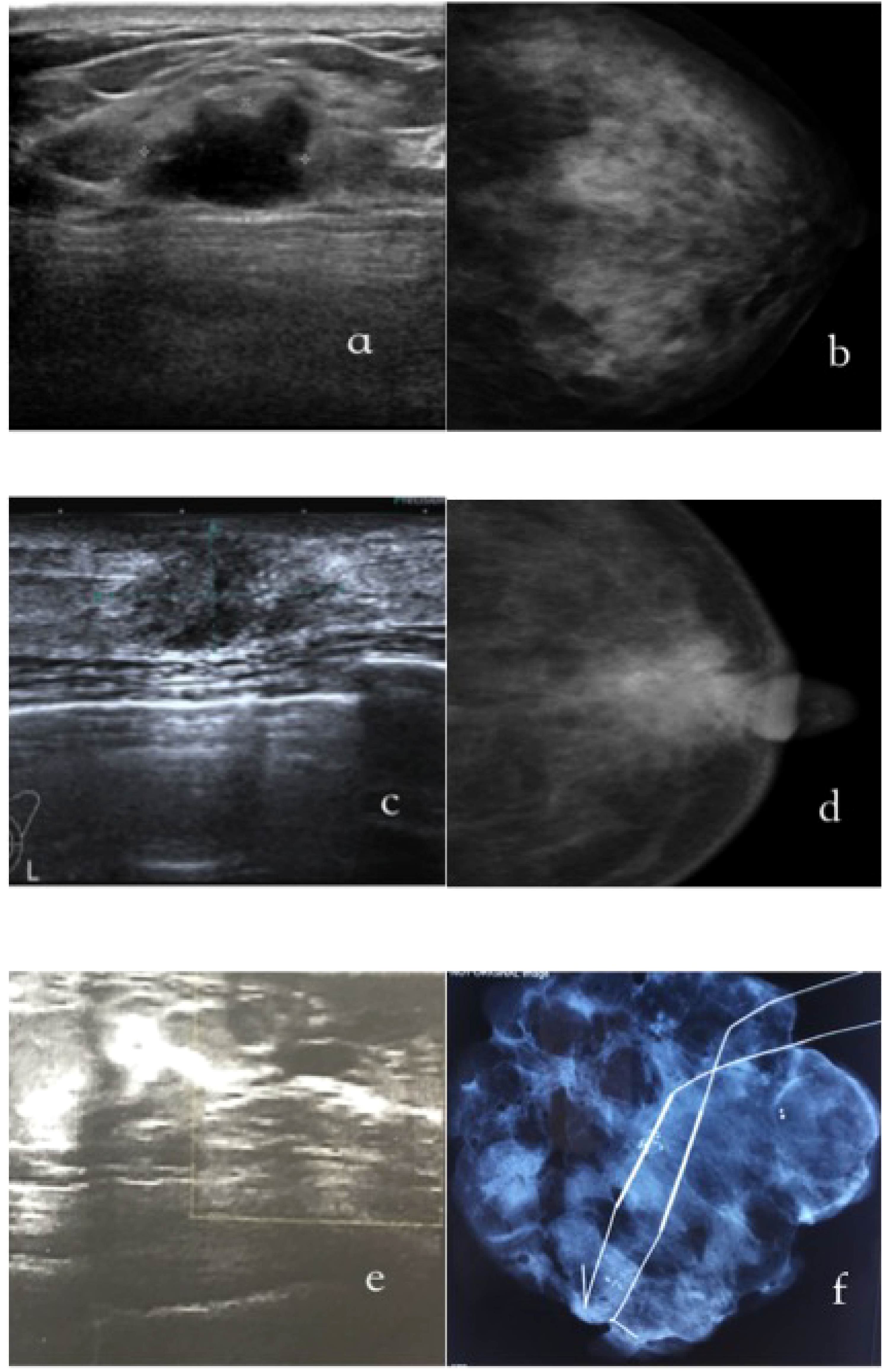 Ultrasound and mammogram images in three pairs. Pair a: Ultrasound with a dark mass beneath tissues; mammogram showing breast density. Pair b: Ultrasound highlighting detailed tissue layers; mammogram with breast profile, indicating contrast. Pair c: Ultrasound showing a light area with potential abnormality; mammogram with complex structure, featuring lines and dense regions.