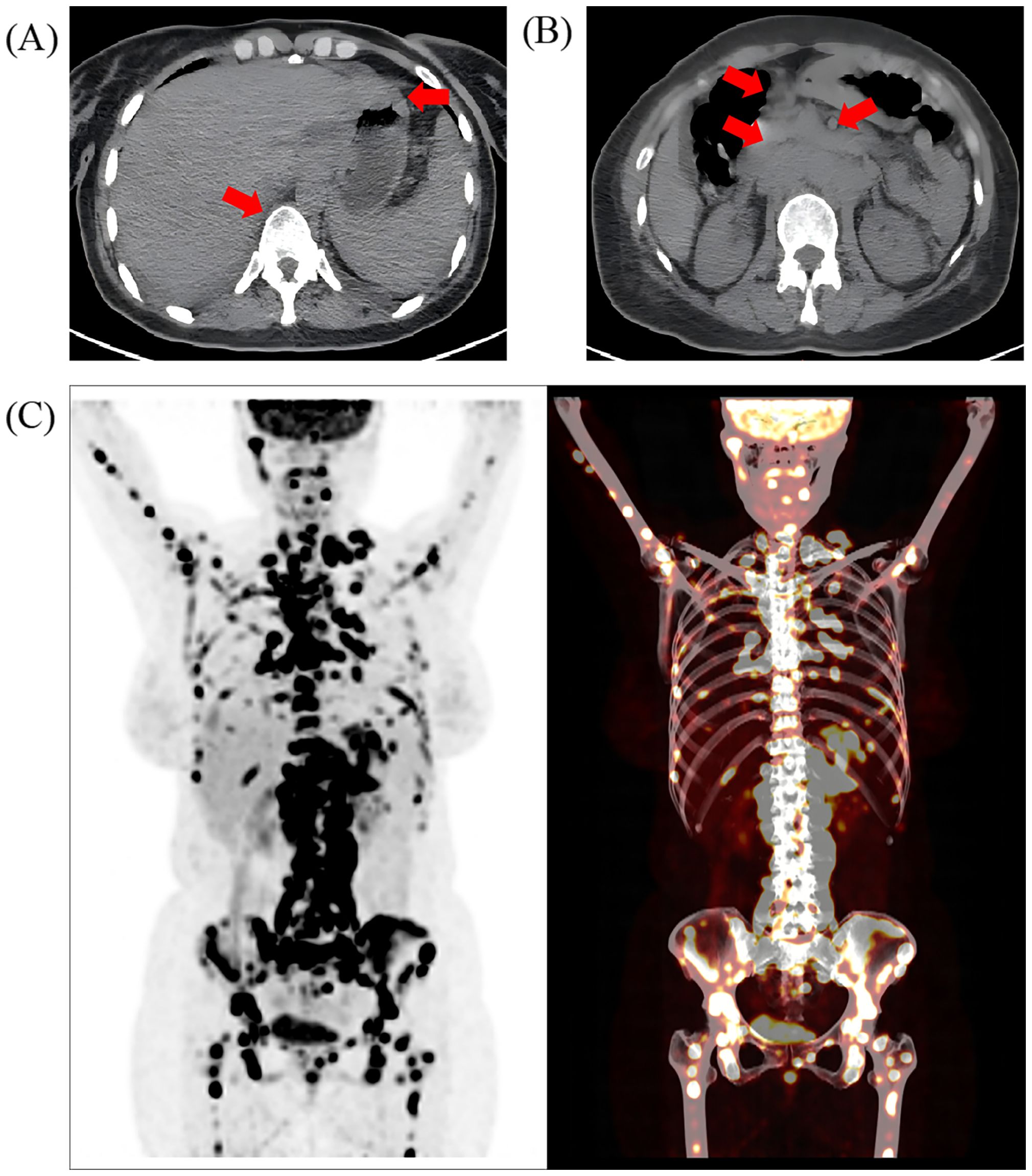 CT and PET-CT scans displaying multiple views of the human body. Panels A and B mark multiple abdominal lesions with arrows. Panel C illustrates disseminated systemic lesions via dual-imaging contrast (dark spots vs. bright spots).