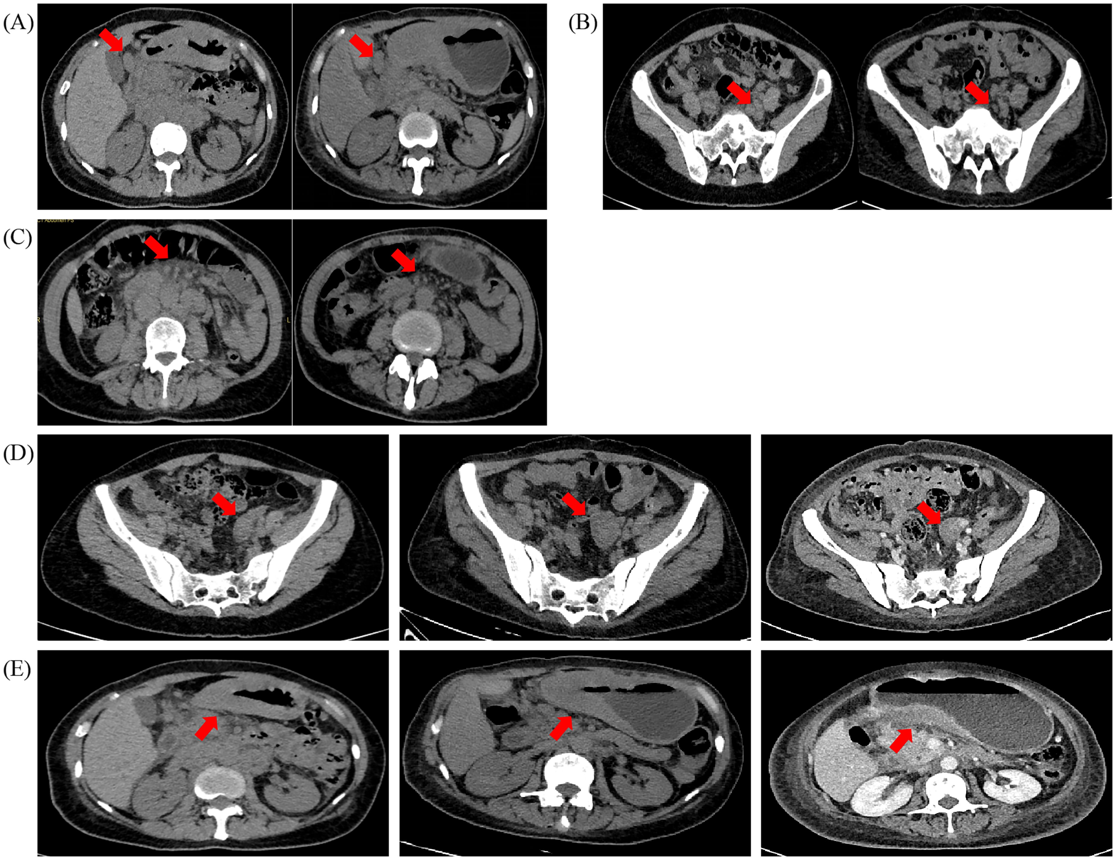 CT scan images showing different abdominal sections. Panels A to E contain multiple scans with red arrows pointing to specific areas of interest, indicating possible abnormalities or areas under examination.