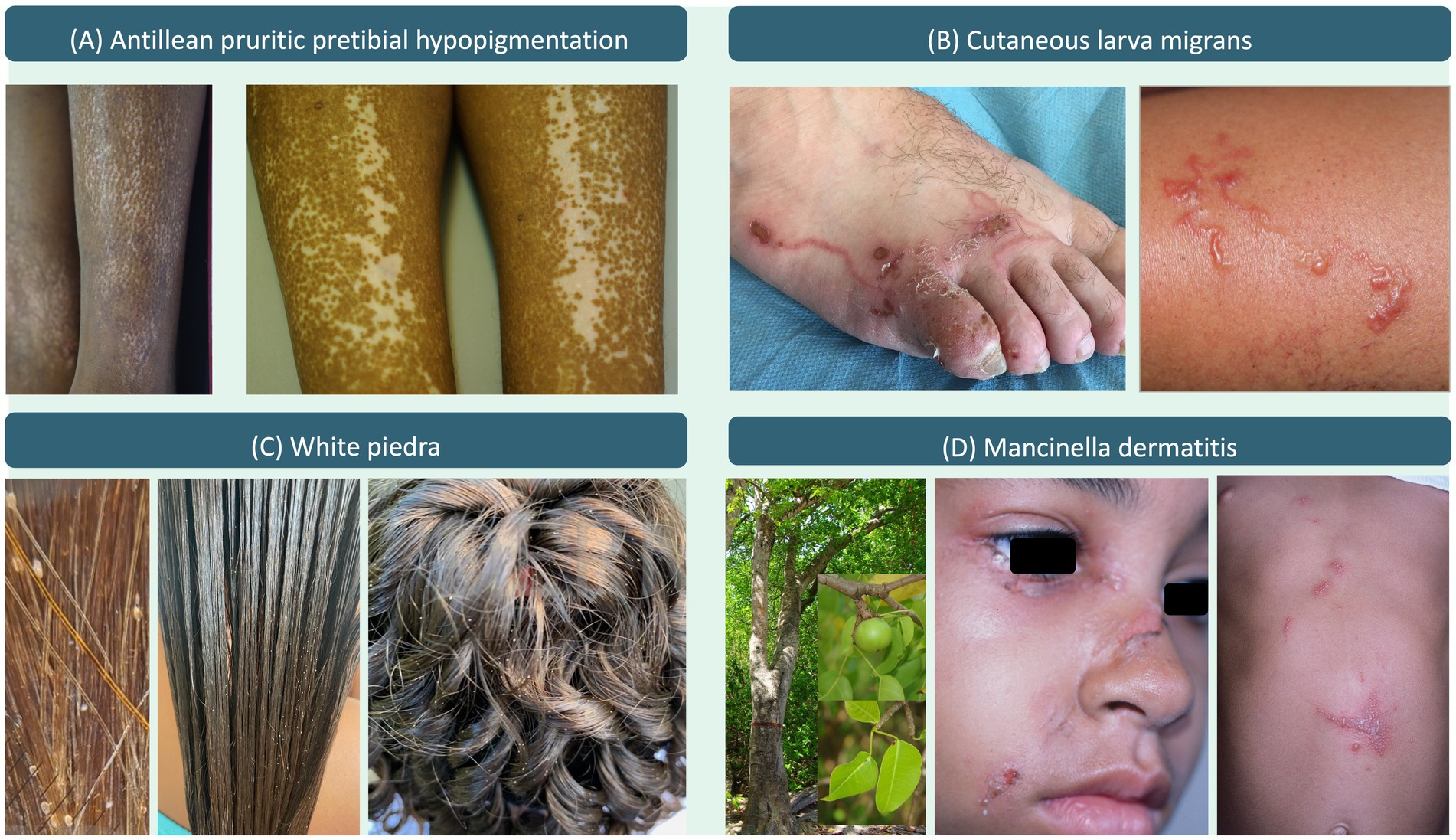 (A) Antillean pruritic pretibial hypopigmentation shows mottled depigmentation on the legs. (B) Cutaneous larva migrans displays serpiginous lesions on the skin. (C) White piedra shows small whitish fungal concretions adherent to hair shafts. (D) Mancinella dermatitis shows linear erythema with contact vesicles, with an image of the responsible tree included.