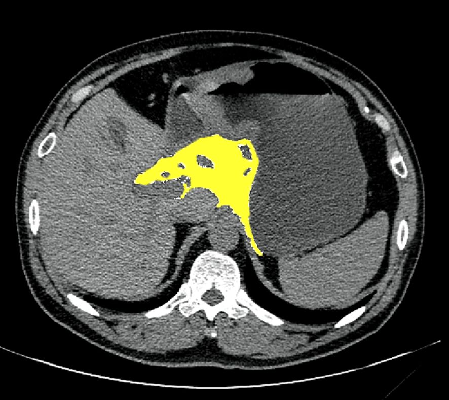 CT scan of the abdomen showing an irregular, yellow-highlighted area on the right side, indicating a potential abnormality. The spinal column and surrounding tissue are visible in grayscale.
