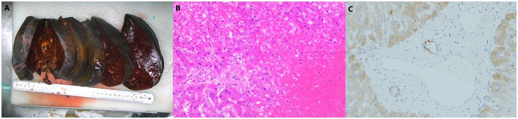Panel A shows multiple cross-sections of a dark brown organ, likely the liver, with varying textures. Panel B displays a pink-stained tissue slide under a microscope, showing cell structures. Panel C presents another stained tissue section with light brown and blue areas, possibly indicating cellular components or structures.
