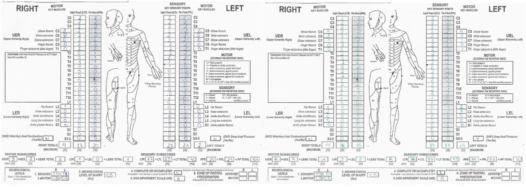 Medical chart displaying sensory and motor function assessments for right and left sides of the body. Includes diagrams with labeled key sensory points, motor key muscles, and numerical scores for light touch and pin prick responses. Total scores and additional notes are provided.