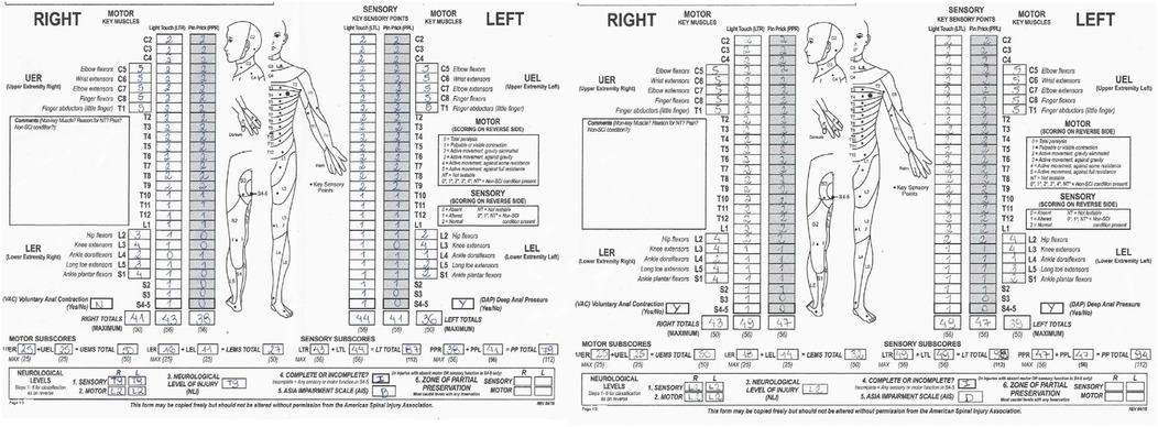 A medical chart showing a diagram of the human body with sensory and motor evaluation scores for both right and left sides. The chart lists key sensory and motor points, highlighting upper and lower extremity function through light touch and pin prick scores. It includes sections for UER, LER, UEL, and LEL, along with total scores for sensory, motor, and neurological levels of injury. Various scales and scoring guidelines are provided for interpretation. The form is from the American Spinal Injury Association.