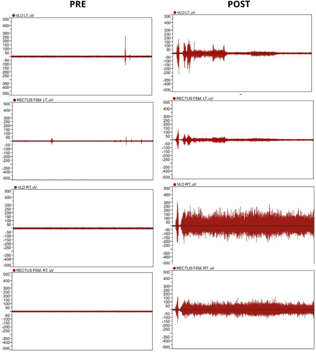 Electromyography graphs comparing muscle activity \