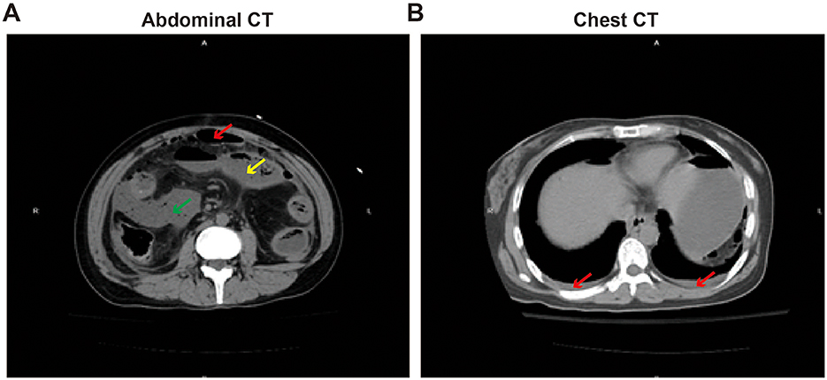 CT scans showing two different sections. (A) an abdominal CT scan with red, yellow, and green arrows indicating specific areas of interest. (B) a chest CT scan with red arrows highlighting certain features. Both images provide a cross-sectional view of the respective body parts.