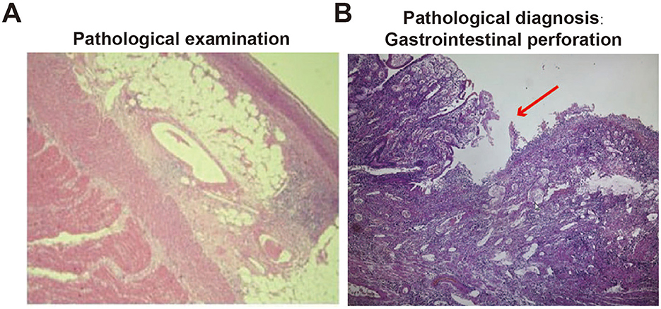 Pathological examination of perforated small intestine. (A) a histological section labeled “Pathological examination,” depicting tissue structures under a microscope. (B) a section labeled “Pathological diagnosis: Gastrointestinal perforation,” with a red arrow indicating the perforation area in the tissue.