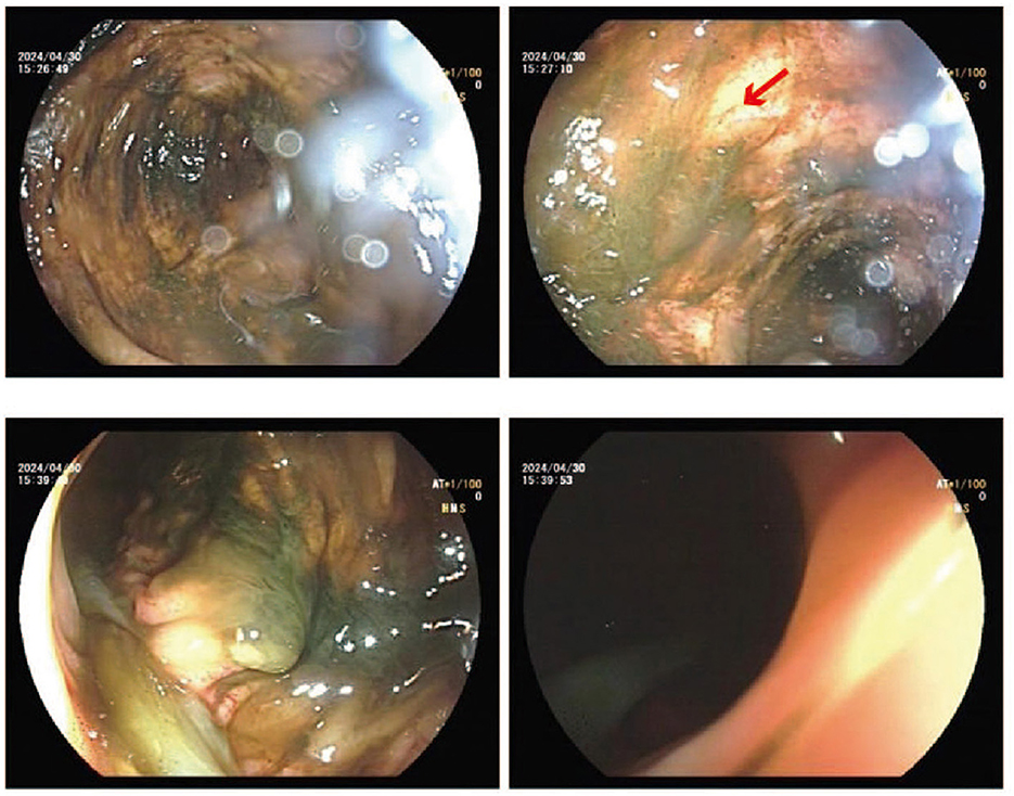 Four endoscopic images of the colon are presented. The initial and third images reveal internal perspectives showcasing an array of textures and hues. The second image features a crimson arrow directing attention to a particular area. The fourth image exhibits a more shadowy appearance, likely influenced by the angle or lighting conditions.