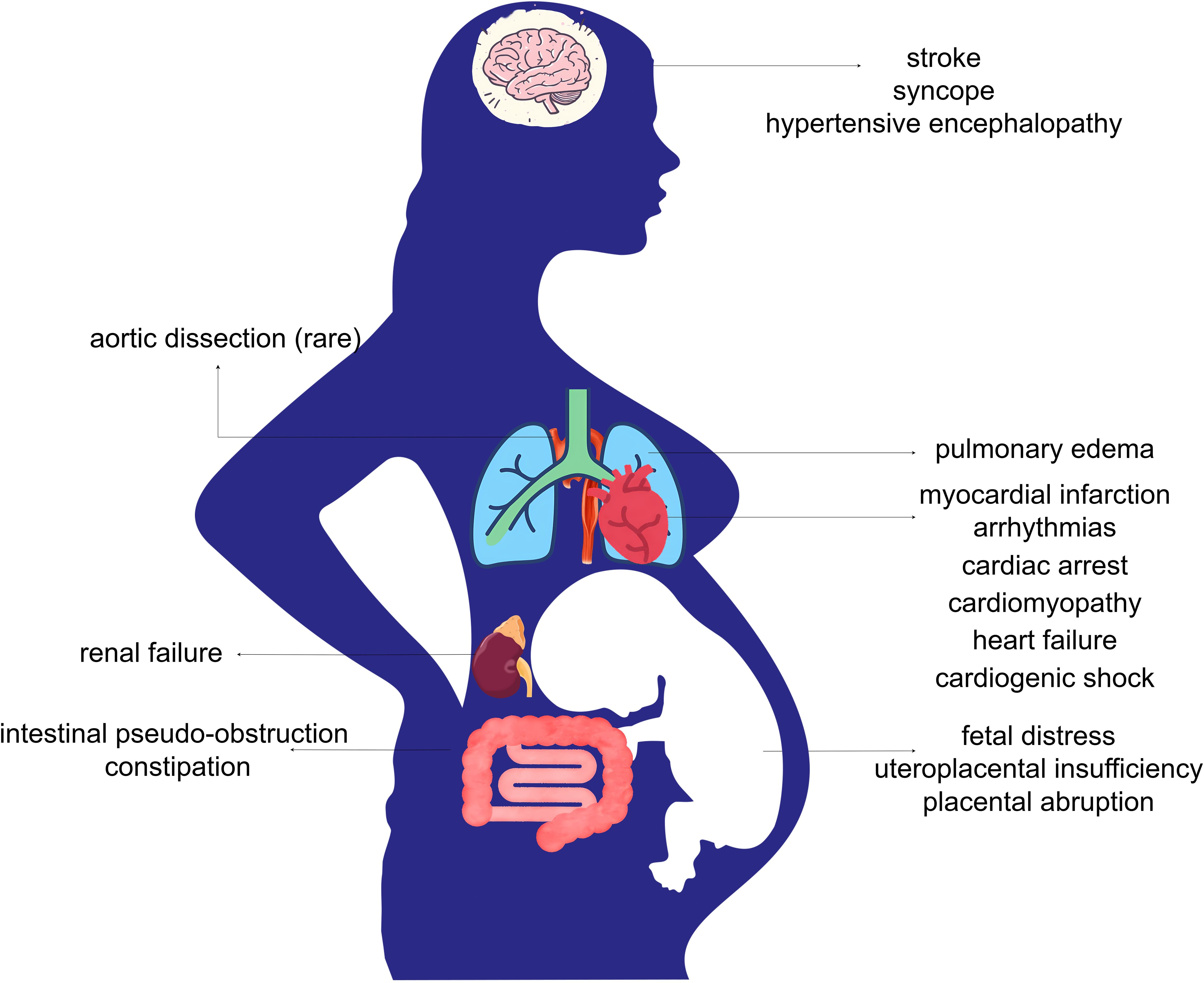 Silhouette of a pregnant woman with internal organs illustrated, showing medical conditions associated with each area. Brain: stroke, syncope, hypertensive encephalopathy. Heart and lungs: aortic dissection, pulmonary edema, myocardial infarction, arrhythmias, cardiac arrest, cardiomyopathy, heart failure, cardiogenic shock. Kidneys: renal failure. Intestines: intestinal pseudo-obstruction, constipation. Uterus: fetal distress, uteroplacental insufficiency, placental abruption.