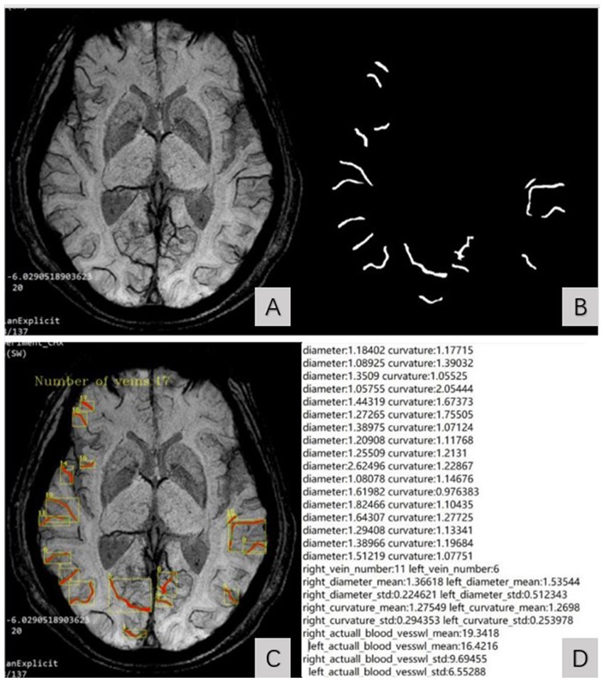 MRI brain scan images with four panels labeled A, B, C, and D. Panel A shows a grayscale axial view of the brain. Panel B highlights white curved lines representing veins. Panel C is similar to Panel A, with veins marked in color, showing “Number of veins: 17”. Panel D lists numerical data on vein diameter, number, curvature and length (vesswl), with metrics on right and left veins.
