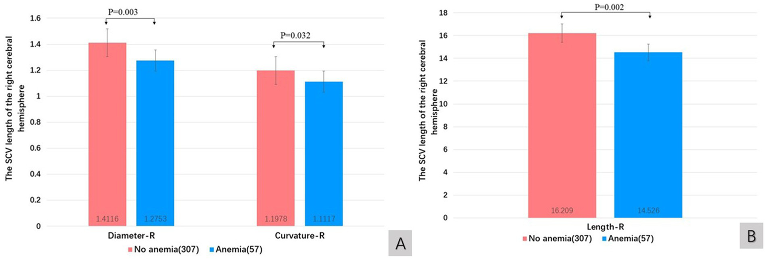 Bar charts compare the quantitative features of SCV in the right cerebral hemisphere between groups with and without anemia. Panel A shows diameter and curvature with significant differences, p-values 0.003 and 0.032, respectively. Panel B shows length with a significant difference, p-value 0.002.