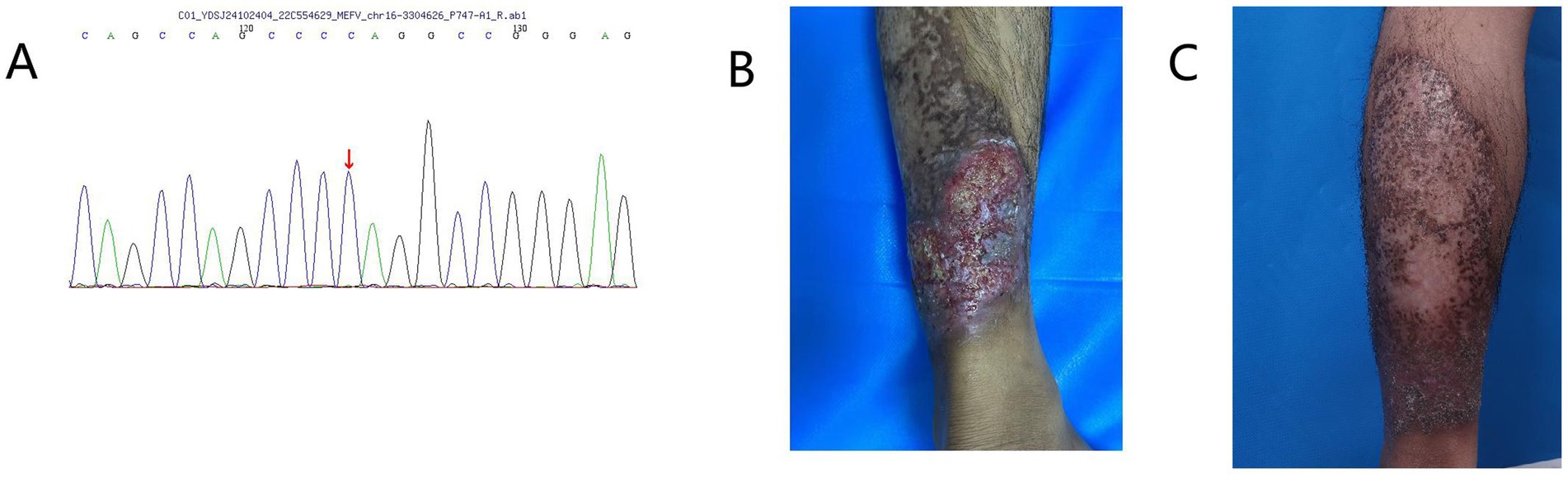 Panel A shows a DNA sequencing chromatogram with an arrow marking a specific peak. Panel B displays a lower leg with a severe skin lesion characterized by extensive ulceration and exudation. Panel C shows the same lower leg with hyperpigmented spots, indicating healing progression.