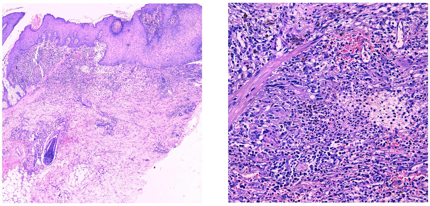 Histological images of tissue under a microscope. The left image shows a wider view with varying cell structures and textures. The right image provides a close-up of densely packed cells, highlighting different morphological features with more visible details. Both images demonstrate variations in staining, indicating different cellular components and structures.