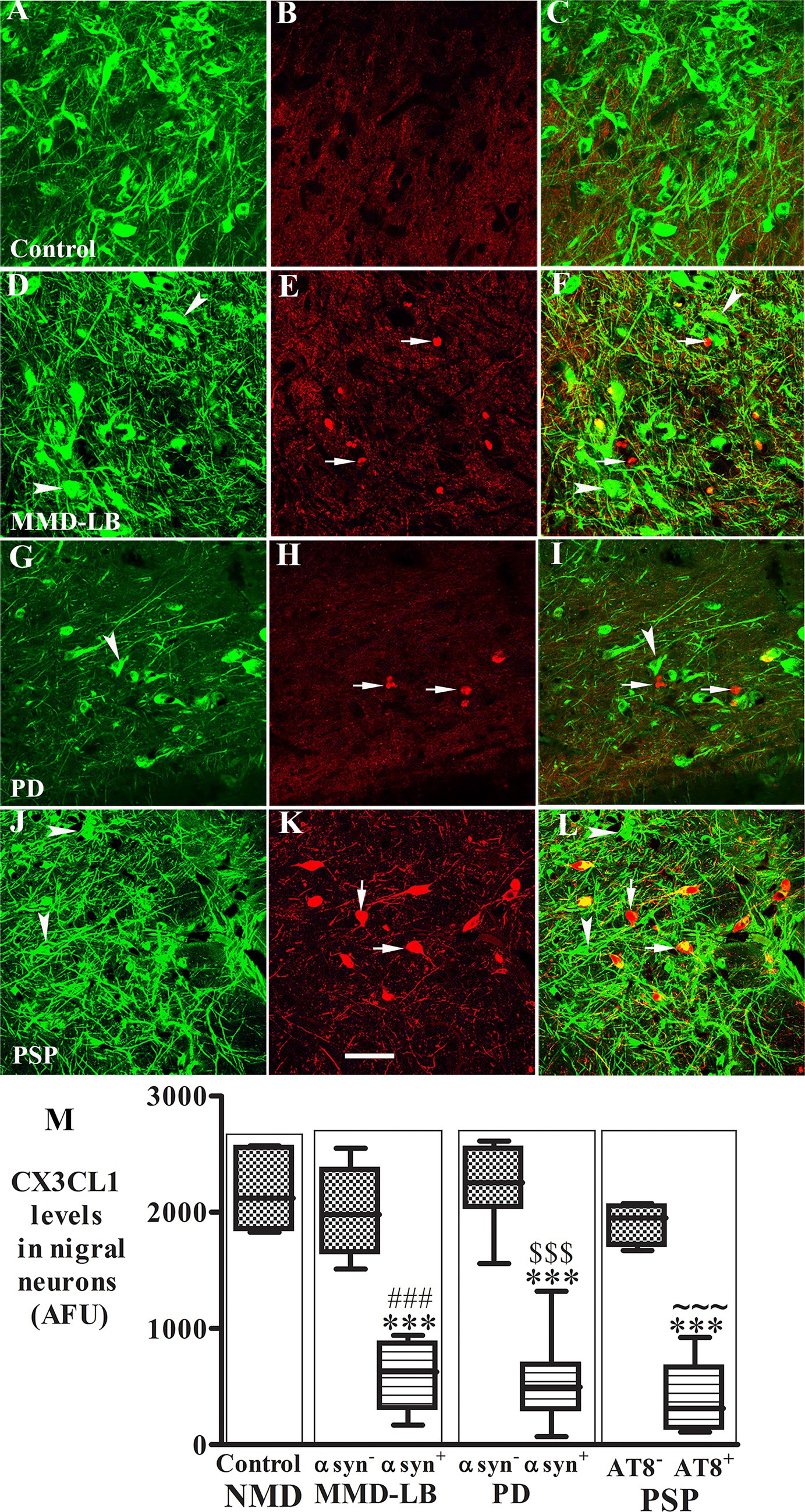 Fluorescent microscopy images showing green and red staining of nigral neurons across different conditions: Control (A-C), MMD-LB (D-F), PD (G-I), and PSP (J-L). Arrows indicate specific features or staining differences. A box plot (M) illustrates CX3CL1 levels in nigral neurons with various markers noted, comparing Control, MMD-LB, PD, and PSP conditions.