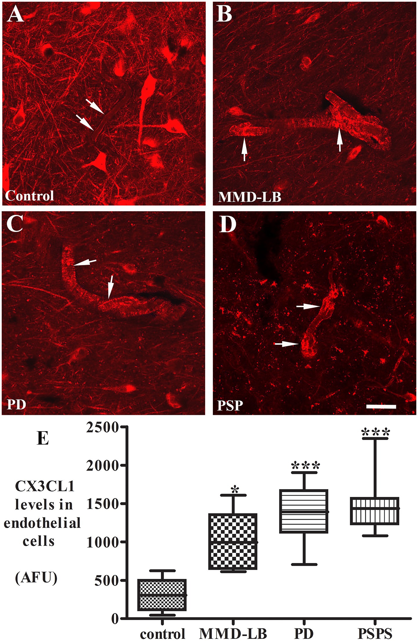 Fluorescent microscopy images A-D show red-stained endothelial cells in different conditions: Control (A), MMD-LB (B), PD (C), and PSP (D), with arrows indicating specific structures. Image E is a box plot comparing CX3CL1 levels in endothelial cells across the conditions: control, MMD-LB, PD, and PSP, showing increased levels marked with asterisks indicating statistical significance.