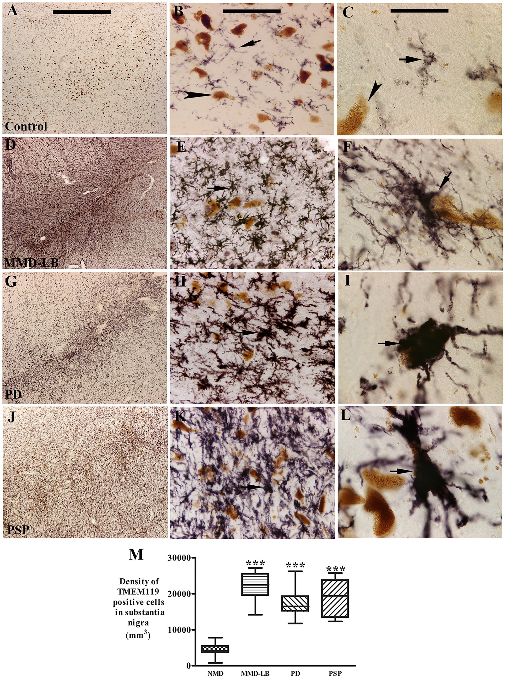 Microscopic images labeled A to L show cellular structures in different brain conditions, including control, MMD-LB, PD, and PSP. Images depict varying densities and types of cells, marked by arrows. Image M displays a boxplot chart comparing the density of TMEM119 positive cells in the substantia nigra across these conditions, highlighting significant differences.