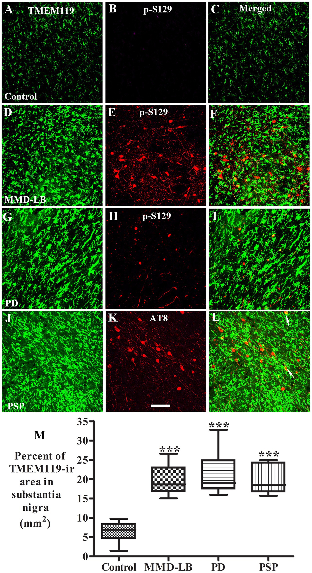 Immunofluorescence images of brain tissue sections, labeled for TMEM119 in green and p-S129 in red, from control, MMD-LB, PD, and PSP groups. Merged panels show overlapping expressions. Panel M displays a box plot comparing the percent area of TMEM119-immunoreactivity in the substantia nigra, with significant increases in MMD-LB, PD, and PSP groups compared to control.