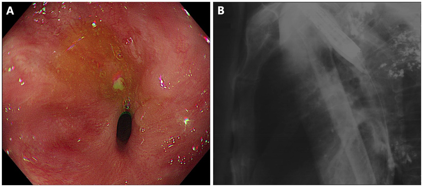 Image A shows an endoscopic view of the esophagus with a red, inflamed surface, and a small ulcer with a dark center. Image B is a chest X-ray showing the esophagus's outline with faint visibility due to overlapping structures.