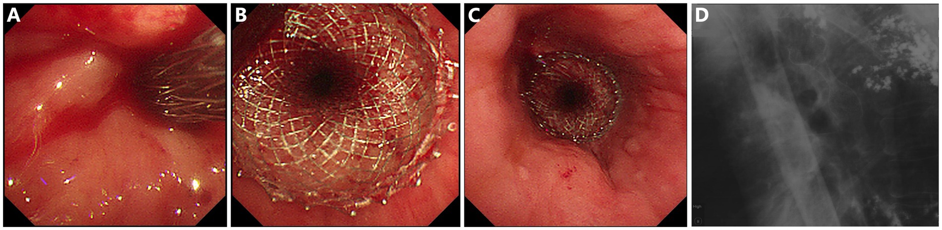 Panel A shows an endoscopic view of esophageal tissue with inflammation. Panel B displays a metallic stent placed in the esophagus. Panel C shows the stent positioned with clear surrounding tissue. Panel D is an X-ray image of the esophageal area, highlighting the stent's location.