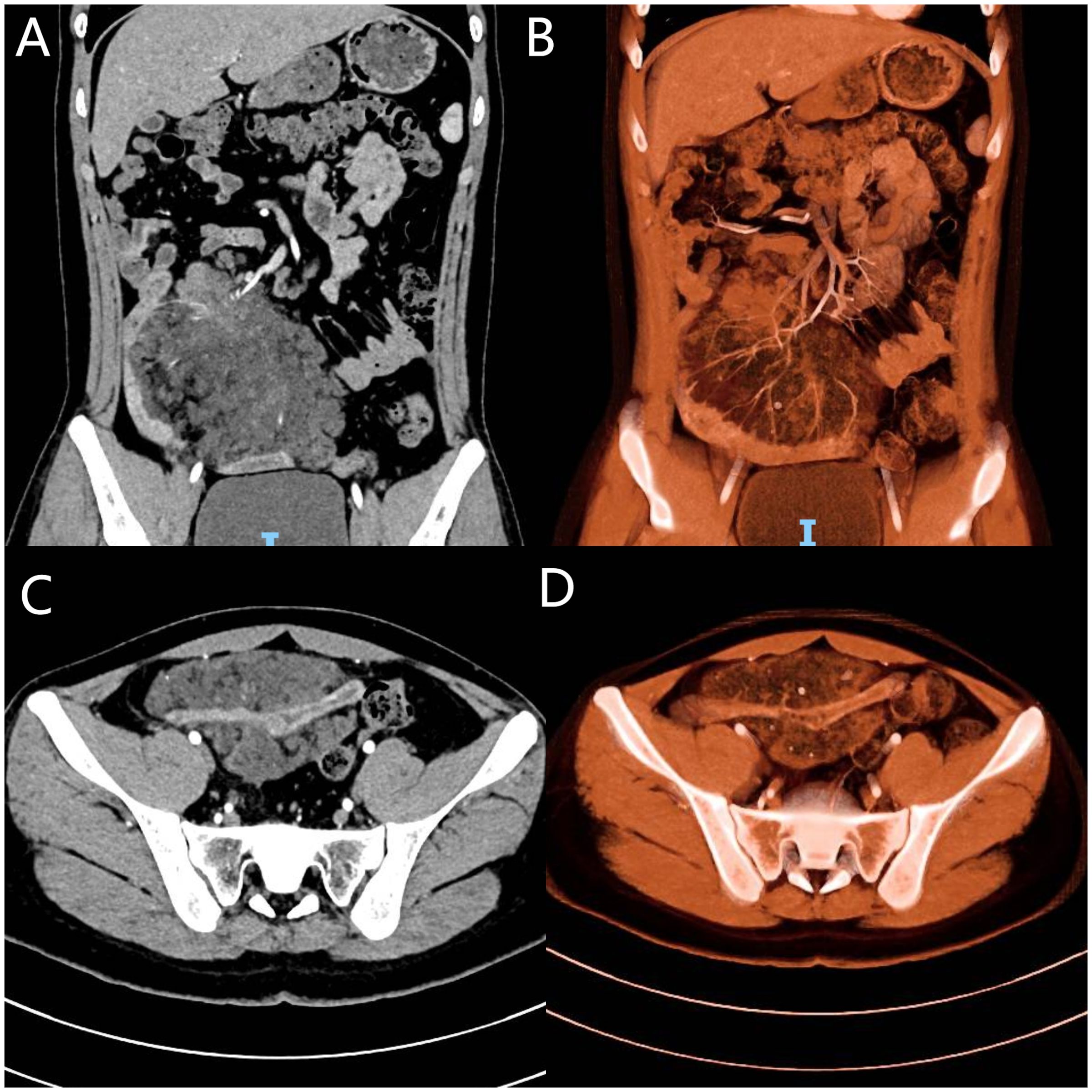 CT scan images labeled A, B, C, and D showing different views of the abdominal region. A and C are in grayscale, displaying structural details. B and D arein a reddish tint, highlighting vascular and soft tissue details.