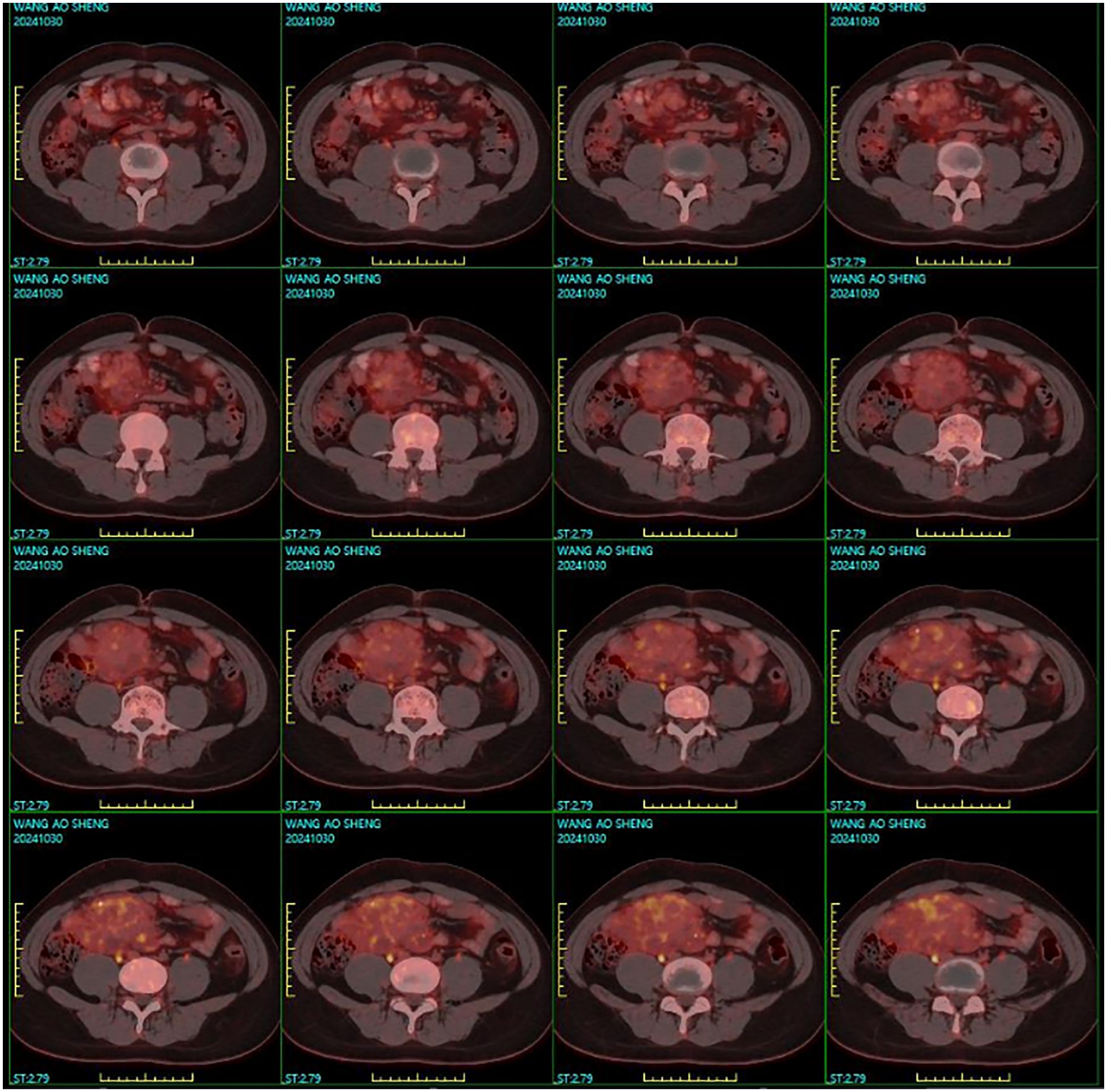 Sixteen-panel medical imaging scan showing cross-sectionalviews of an abdominal region. Areas of various intensities highlight different structureswithin the body, indicating anatomical features or possible abnormalities.