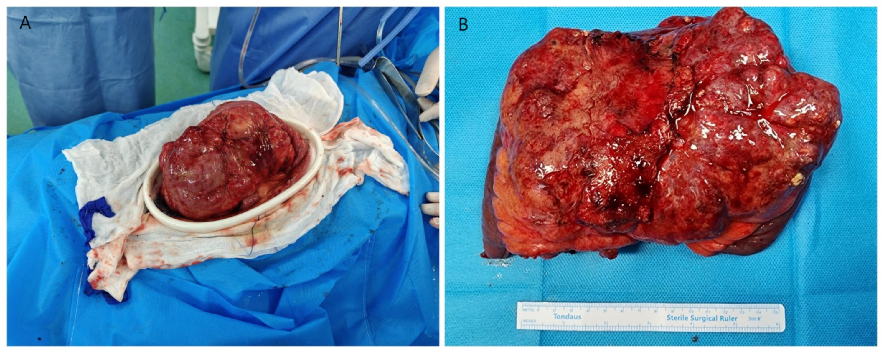 Panel A shows a large, reddish tumo rplaced inside a surgical trayon a blue draped surface. Panel B displays the same tumor on a sterile blue surgical clothwith a ruler for scale, emphasizing its size and texture.