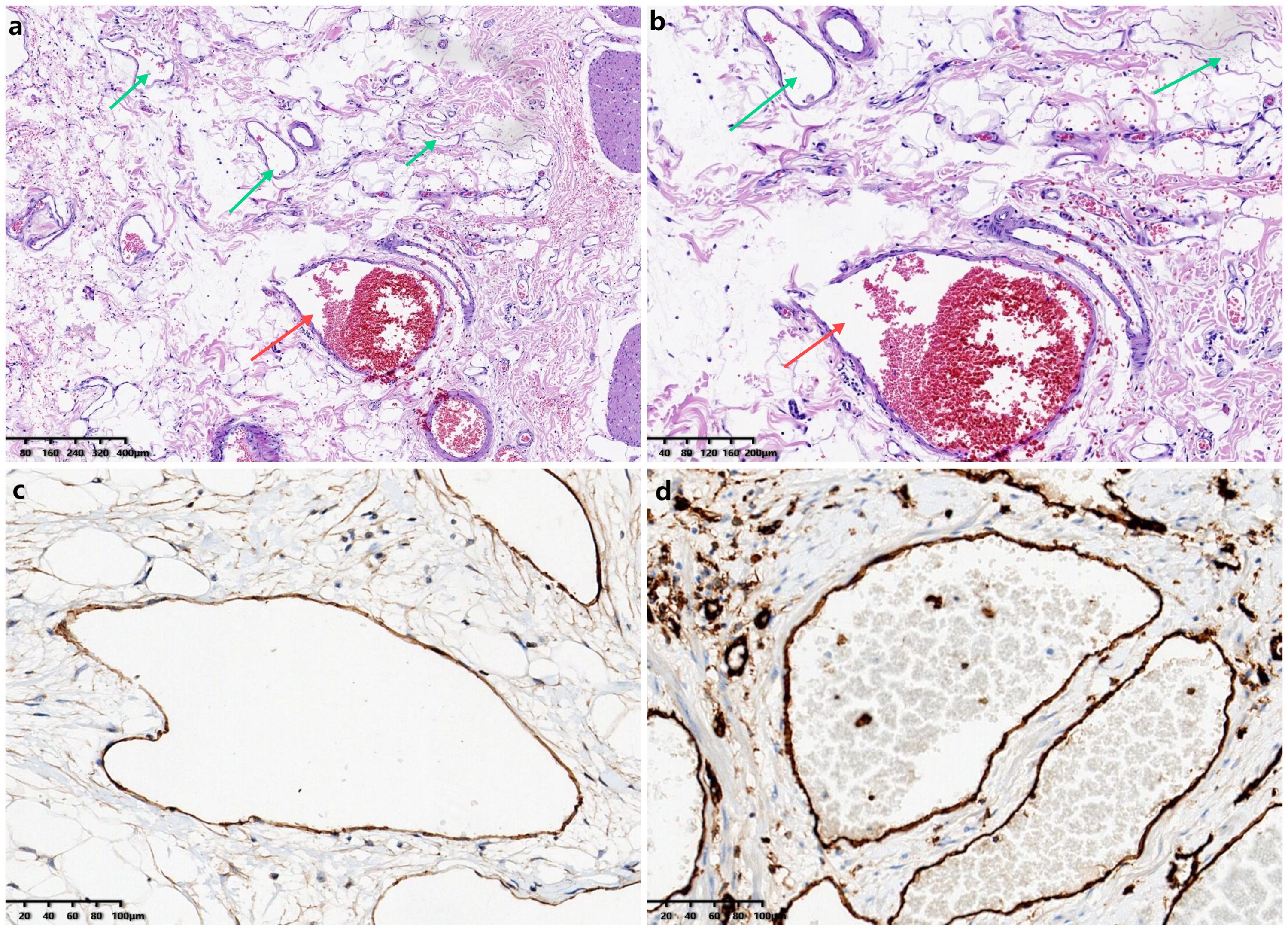 Histological slides show tissue samples stained to highlightstructures. Panels a and b display vascula rand fibrous tissues with arrows indicatingspecific features.Panels c and d focus on cellular and structural detail, possibly withimmunohistochemical staining. Scales are provided for measurement reference.