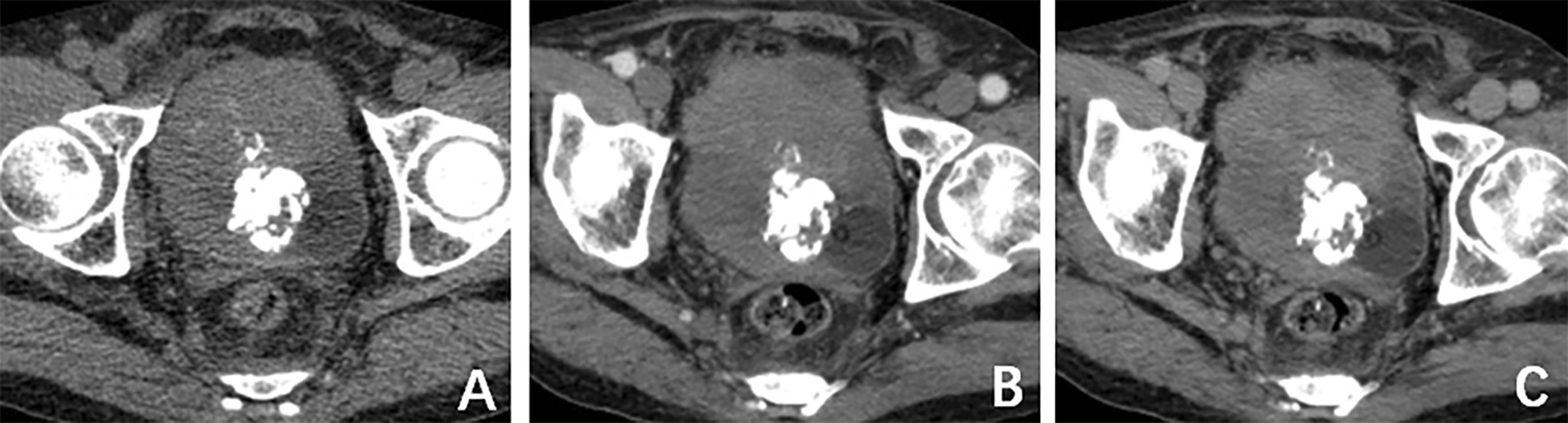 Three-panel CT scans labeled A, B, and C, displaying cross-sections of the pelvic region. Each panel shows the pelvic bones, surrounding soft tissue, and internal structures with varying densities. The images appear to focus on differences in tissue composition or abnormalities.