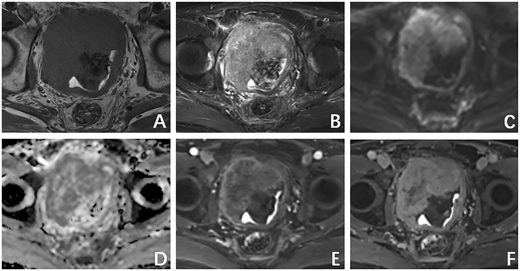 Six MRI scans display an abnormal mass in the pelvic region. Panels D to I show different imaging sequences and perspectives. The mass appears with varying intensities, suggesting analysis of its features through distinct MRI techniques. Each panel highlights specific aspects of the mass for comprehensive assessment.