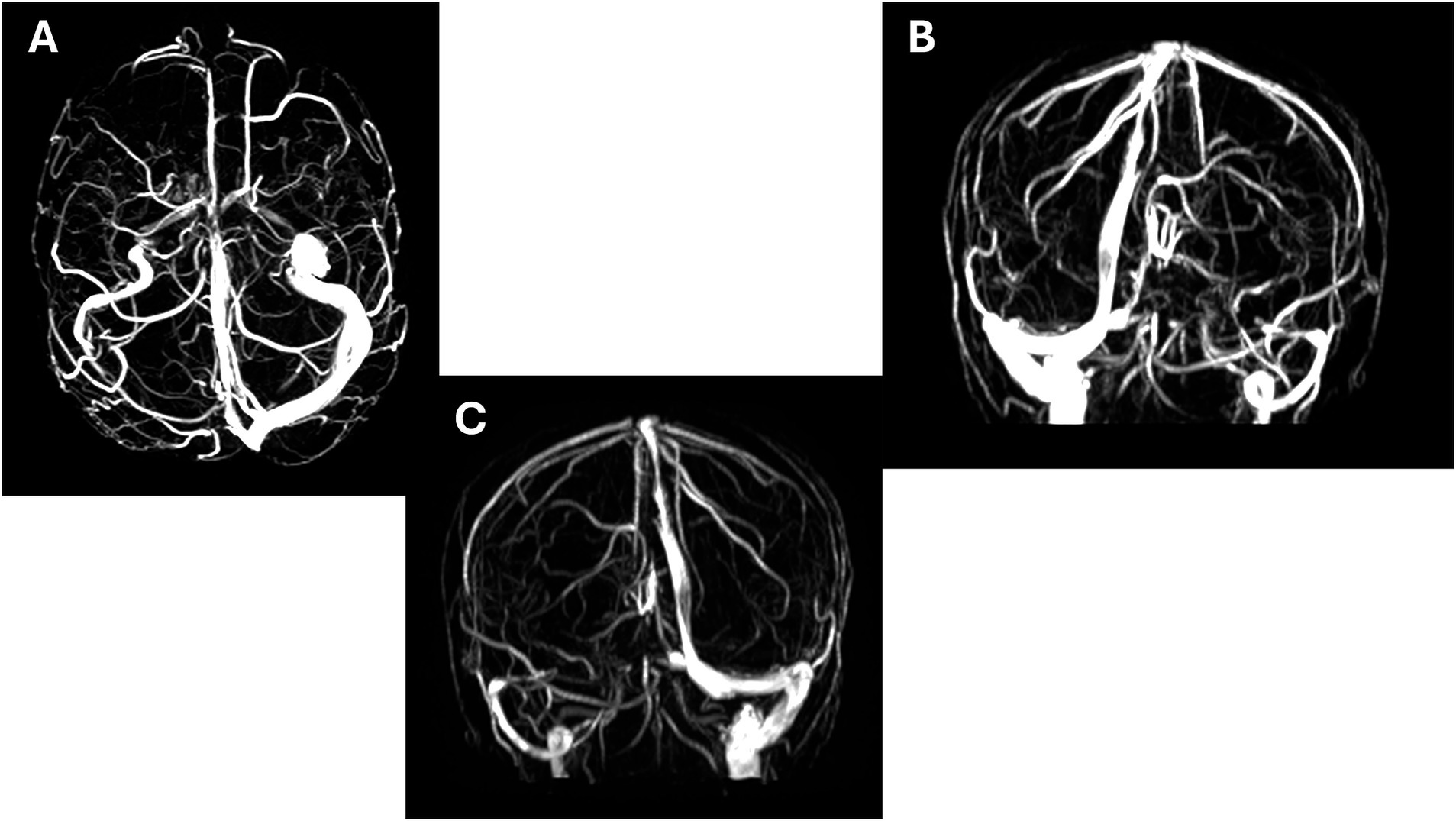 Three angiographic images labeled A, B, and C show the blood vessels in the brain. Image A displays a dense network of vessels, primarily in the center. Image B shows a slightly different pattern with more prominent vessels near the top. Image C highlights thinner vessels distributed more evenly. All images use contrast to highlight arterial structures.