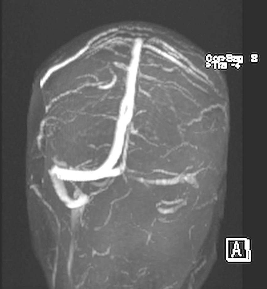 MRI scan of a human head, showing a prominent blood vessel with high contrast, likely an artery. The vessel runs vertically along the brain's surface. Some text and technical details are blurry.