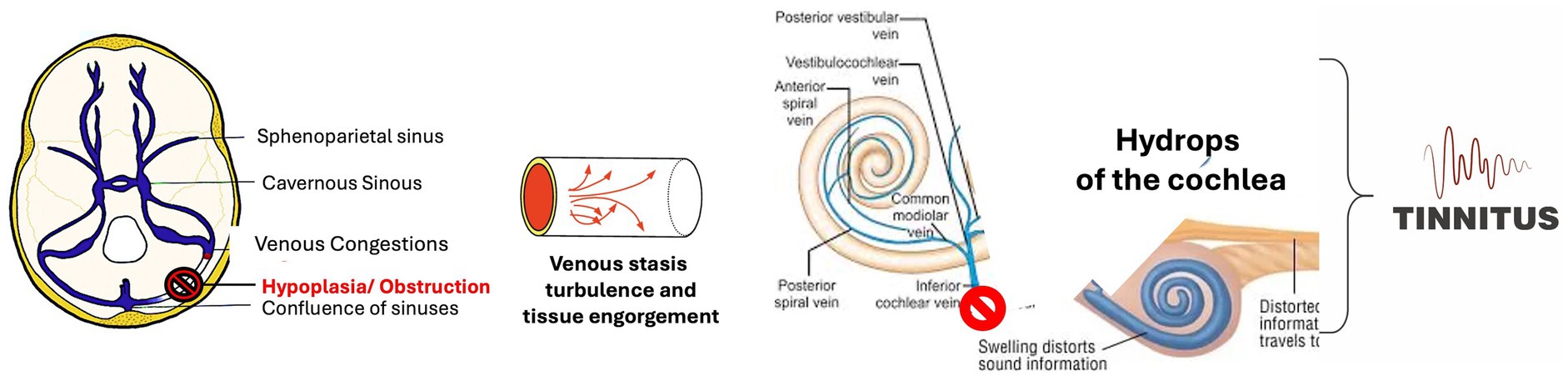 Diagram illustrating the process of tinnitus development. It shows venous congestion in the sinuses, hypoplasia or obstruction, leading to venous stasis and turbulence. This affects the cochlea, causing swelling that distorts sound information, resulting in tinnitus.