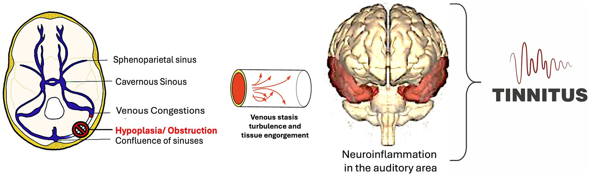 Diagram showing a transverse view of the brain and sinuses. Labels indicate spheno-parietal sinus, cavernous sinus, venous congestions, and hypoplasia/obstruction at the confluence of sinuses. An inset shows venous stasis and associated turbulence, linking to neuroinflammation in the auditory area and correlating with tinnitus, as suggested by a sound wave illustration and the word